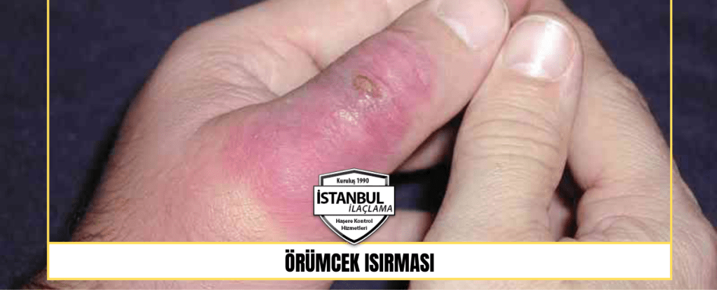 Örümcek Isırması