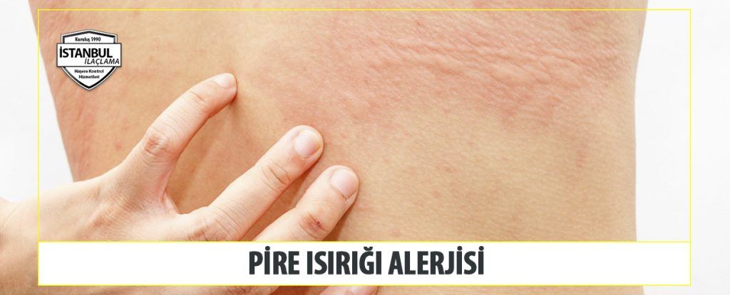 Pire Isırığı Alerjisi